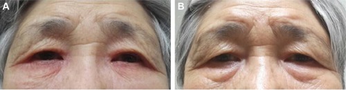 Figure 1 (A) Bilateral eczematous periorbital swelling after instillation of dorzolamide eyedrops. (B) Improved periorbital swelling after cessation of dorzolamide eyedrops.