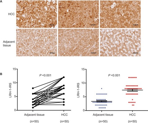 Figure 1 LRH-1 was frequently upregulated in HCC clinical specimens.Notes: (A) LRH-1 immunohistochemistry. Three representative micrographs of LRH-1-immunostained tissue microarray spots of HCC and adjacent tissues. Magnification, ×400; bars, 30 µm. The cells in tumor-adjacent tissues showed detectable or weak nuclear immunoreactivity. Intense nuclear immunosignals were detected in cancer cells in HCC tissues. (B) LRH-1 IRS analysis performed on HCC and adjacent tissues. Results showed that HCC tissues showed significantly higher LRH-1 expression than tumor-adjacent tissues. P<0.001 vs tumor-adjacent tissues.Abbreviations: HCC, hepatocellular carcinoma; IRS, immunoreactivity score.