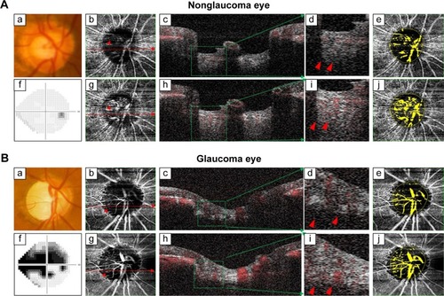 Figure 1 Clinical examinations of a subject without glaucoma (A) and with glaucoma (B) are shown.