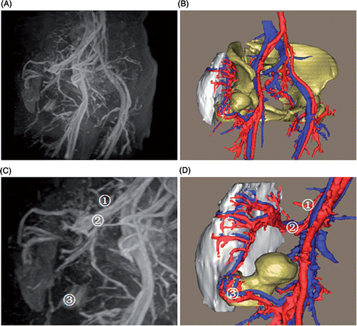 Figure 6. 3D model of the tumor blood supply. (A) The MRA appearance of pelvic vessels. (B) The 3D models of the pelvic vessels, tumor and bones. (C) The MRA appearance of the tumor blood supply from small branches of the internal iliac artery (1), superior gluteal artery (2), and a communicating branch of the lateral femoral circumflex artery (3). (D) The 3D models of the tumor blood supply, where (1), (2) and (3) are the same vessels shown in (C). The 3D model accurately reproduces the in vivo tumor-related vessels, and additionally demonstrates the spatial relationships between the tumor and peritumoral vessels.