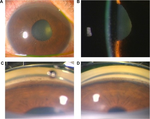 Figure 1 Ocular findings at presentation.