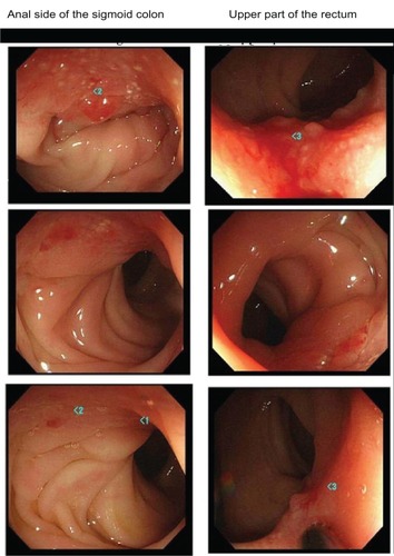 Figure 2 Changes in lower gastrointestinal endoscopic images. Upper images, taken in 2009; middle images, taken in 2010; lower images, taken in 2011.