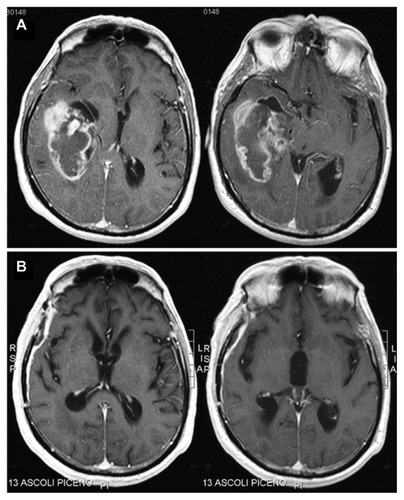 Figure 1 Contrast-enhanced, axial, T1-weighted magnetic resonance images of the tumor.
