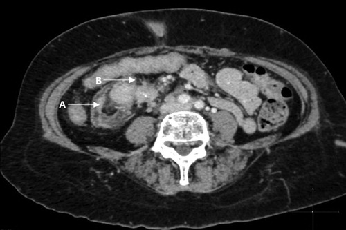 Figure 3: Abdominal CT showing intussusception of the distal ileum (A) with no signs of small bowel obstruction and a desmoplastic reaction (B) with typical findings of linear opacities radiating outwards in a ‘spoke wheel’ or stellate pattern, with ‘in-drawing’ of the surrounding tissues.