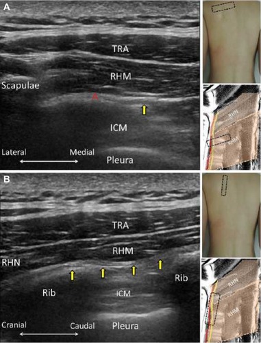 Figure 4 The short axis (A) and long axis (B) views of the dorsal scapular nerve (yellow arrows).