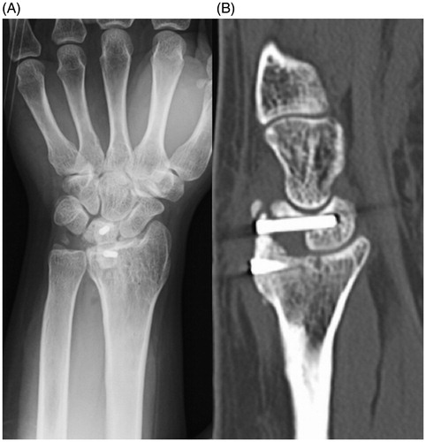 Figure 2. (A) Immediately postoperative radiograph of the radiolunate arthrodesis with the iliac crest. (B) Radiograph at 6 months after the first radiolunate arthrodesis showing nonunion.