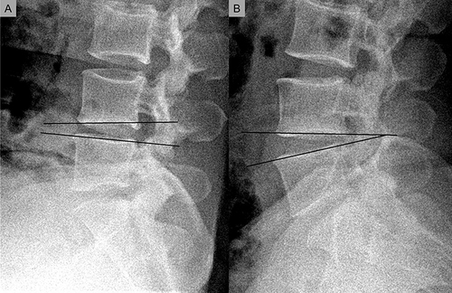 Figure 2 Angular instability in the sagittal flexion (A) and extension (B) views on plain radiography. Black line indicates the angular changes of adjacent upper and lower vertebra that occurs during flexion and extension.