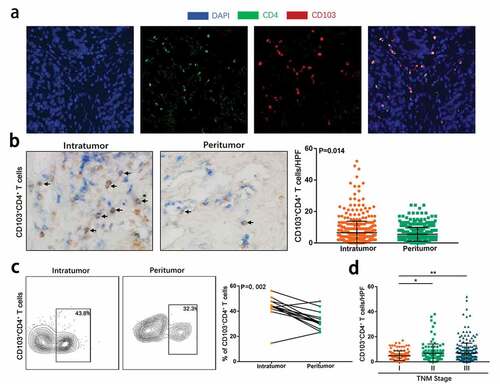 Figure 1. CD103+CD4+ T cells accumulate in gastric cancer and associates tumor progression. (a) Representative immunofluorescence staining with CD4(green), CD103 (red) and DAPI (blue) in gastric cancer tissues. (b) Representative dual immunohistochemical staining images(left) for CD4(blue) and CD103(brown) and quantitative analysis(right) of CD103+CD4+ T cells in intratumoral tissues (n = 469) and corresponding peritumoral tissues (n = 469). Significance was assessed by unpaired t test. (c) Representative flow cytometry (FCM) analysis images (left) and quantification (right) of CD103+CD4+ T cells in CD3+ cells in intratumoral tissues and corresponding peritumoral tissues of gastric cancer fresh samples (n = 14). Significance was assessed by Wilcoxon matched-pairs signed-ranks test. (d) Relationship between intratumoral CD103+CD4+ T cells infiltration and TNM stage was examined based on IHC staining. Significance was assessed by unpaired t test. Bar plots show mean ± SD