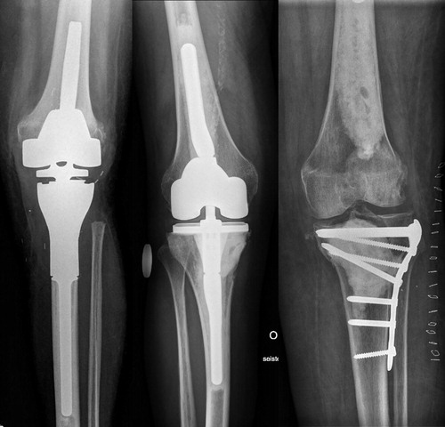 Figure 2. Surgical treatment methods: tumor prosthesis (A), total knee arthroplasty with long cemented stems (B), osteosynthesis using plate and cement (C).