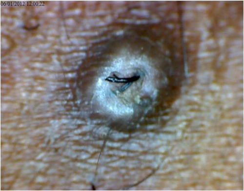 Figure 2 Extra-follicular and transfollicular penetration.