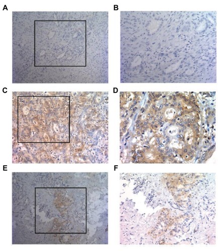 Figure 1 Patterns of PD-L1 expression in primary ICC surgical specimens stained with anti-PD-L1 monoclonal antibody.Notes: PD-L1 staining was detected in a membranous pattern in ICC tissues. (A and B) Samples displaying pattern 1 exhibited negative expression in ICC cells. (A) Original magnification, ×100. (B) Original magnification of the boxed area shown in (A), ×200. (C and D) Samples exhibiting pattern 2 displayed diffuse staining. (C) Original magnification, ×200. (D) Original magnification of the boxed area shown in (C), ×400. (E and F) Samples displaying pattern 3 exhibited regional PD-L1 expression. (E) Original magnification, ×100. (F) Original magnification of the boxed area shown in (E), ×200.Abbreviations: ICC, intrahepatic cholangiocarcinoma; PD-L1, programmed death ligand 1.