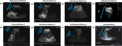 Figure 1 Bedside ultrasound. (A-H): Right pleural effusion is the accumulation of fluid in the area between the layers of the pleura around the right lung, pleural effusion is the separation of the walls of the pleural cavity, and the space is filled with fluid, hydropneumothorax is the unusual accumulation of air and fluid in the pleural space and pneumothorax shows significant lung patches, decreased lung movement, and stratosphere symptoms.