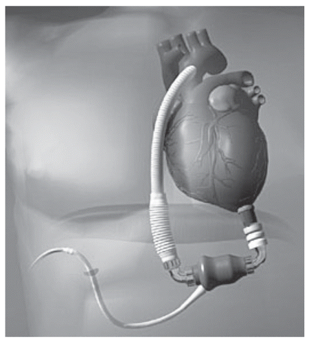 Figure 8 Thoratec Heartmate II LVAD, reprinted with permission from Thoratec Corporation.
