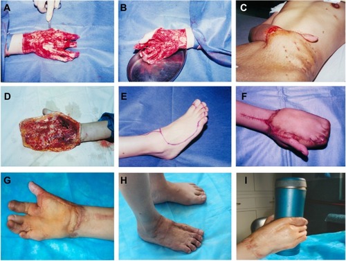 Figure 3 Female patient, 34 years old, with degloving damage involving all of the digits except the thumb.