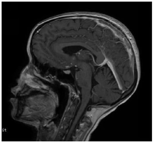 Figure 1 Magnetic resonance imaging T1 weighted image without contrast demonstrating filling defects in the superior sagittal sinus.