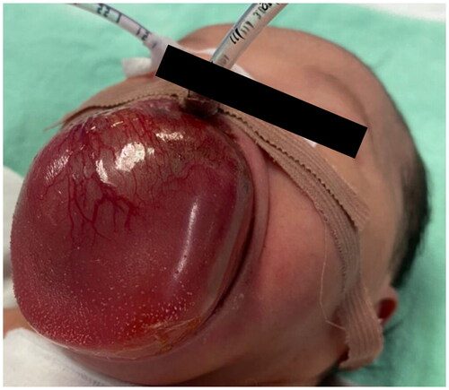 Figure 2. Post EXIT delivery- A huge tongue mass causing expansion of the tongue and oral cavity and protruding out of the mouth.