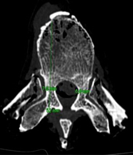 Figure 1. Measure of the maximal diameter of the pedicles and the length of the vertebral body with pedicle (mm).