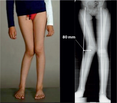 Figure 3. Patient at the age of 12 years, with developing valgus deformity and shortening of the right lower extremity.