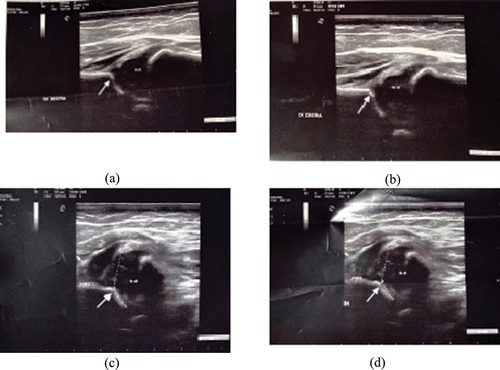 Figure 1. Bilateral hip ultrasound (a, b: right hip; c, d: left hip) at 1 month of age. Left hip type according to Graf: IIIc. At the physical examination, the left hip was subluxated and impossible to reduce. White arrow: acetabulum. **: femoral head.