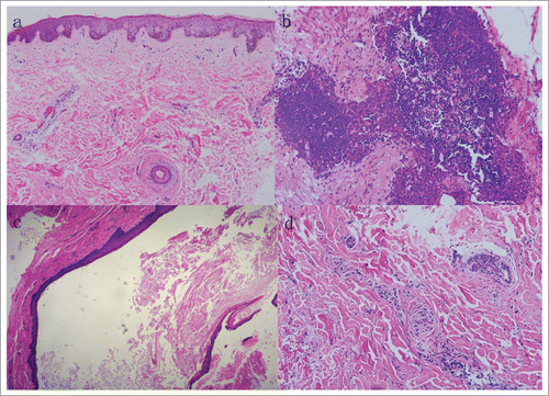 Figure 2. Histopathological changes in patients with scarring folliculitis type of acne inversa. (a) Epidermal hyperpigmentation and fibrosis surrounding hair follicles. (HE × 200). (b) Granulomatous inflammation. (HE × 100). (c) Epidermal cyst. (HE × 200). (d) Destruction of hair follicle and sebaceous gland and collagen hyperplasia. (HE × 200).
