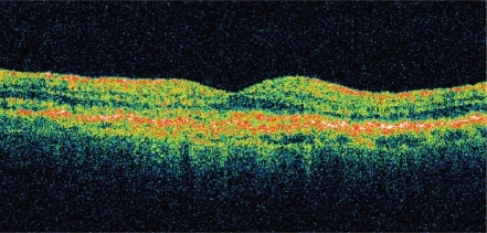 Figure11b OCT of neovascular AMD 1-week post-ranibizumab treatment, visual acuity 20/40. Note significant resolution of intra- and sub-retinal fluid, reduction in macular thickness, and return of foveal contour.