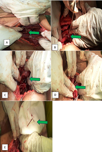 Figure 2 The removal process of CU-IUD from the left adnexa and uterine wall captured in pictures.
