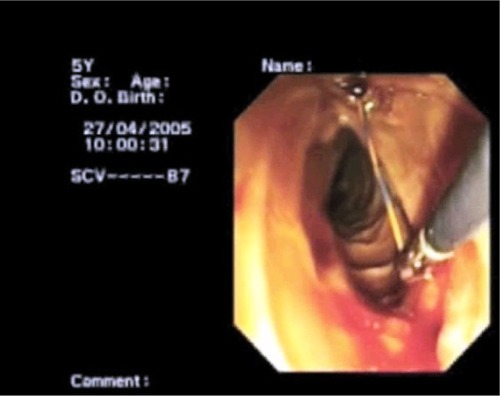 Figure 2 Intraoperative papillotomy with “rendezvous.”