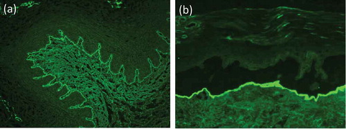 Figure 7. Indirect immunofluorescence microscopy. (a) Linear binding of IgG along the basement membrane on monkey esophagus. (b) IgG locates to the floor of the artificial blister in 1 M NaCl-split human skin.