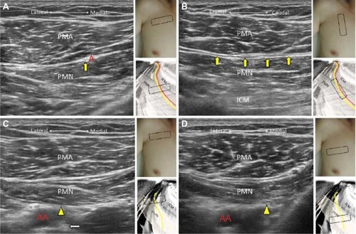 Figure 3 The short axis (A) and long axis (B) views of the lateral pectoral nerve; the short axis views (C) of the medial pectoral nerve at its origin near the medial cord and descending beneath the pectoralis minor muscle (D).