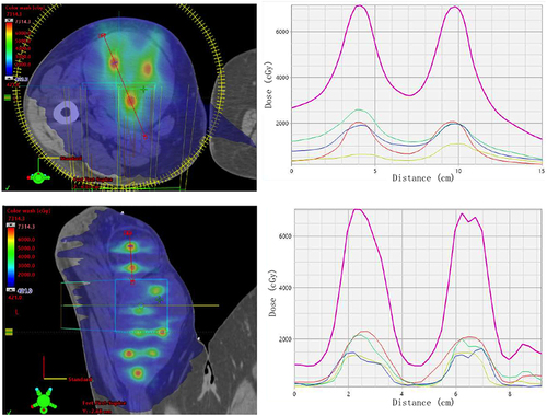 Figure 1 LRT plan. Upper left: dose distribution in an axial plane. Upper right: peak-valley dose profiles defined by the red line across the two dose vertices. Lower left: dose distribution in a coronal plane. Lower right: peak-valley dose profiles defined by the red line across the two dose vertices. The dose profiles contain individual arcs (lower 4 curves) and combined-arcs (upper curve).