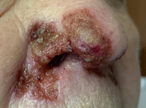 Figure 5 The ulceration covered with serous crust including the tip of the nose with the destruction of the right ala of the nose spreading to the upper lip.