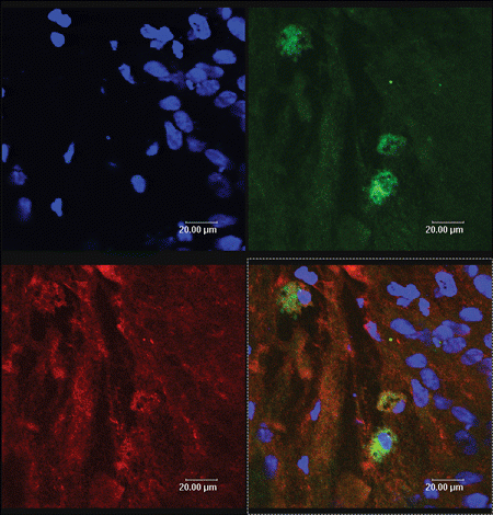 Figure 2. The yellow color sites (arrow) represent these PKH67 labeled MSCs (green) and their expression of GFAP (red).