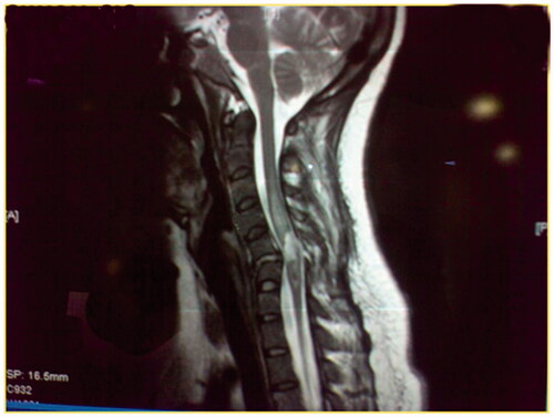Figure 4. A T2W MRI image of a 25-year-old male involved in MVA that resulted C5–C6 fracture, classified as ASIA A, no surgical intervention. After 15 months he developed s focal cyst opposite to the fracture site.