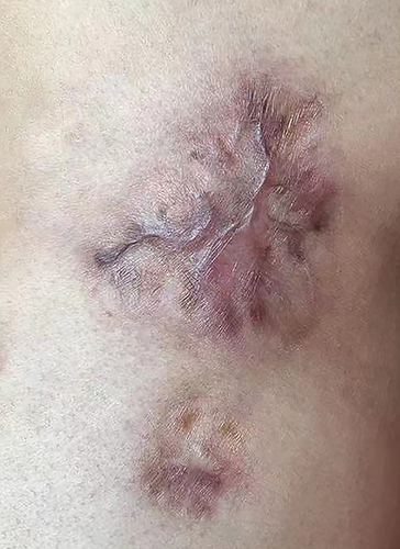 Figure 7 Clinical photograph of the patient: After 6 rounds of chemotherapy with the CHOP regimen.