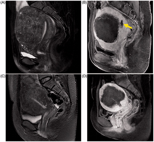 Figure 1. MRI images of the sagittal view in patients with adenomyosis. (A, C) T2-weighted images pre-ablation; globally enlarged uterus with local and diffuse widening of junctional zones can be seen in each image. (B, D) T1-weighted contrast-enhanced images showing non-perfused lesions corresponding to the ablated necrotic zone of A and C post-PMWA; the yellow arrow identifies the endometrium.