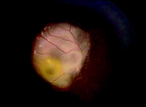 Figure 1.  Ophthalmoscopic examination of Case 1. Ophthalmoscopic examination at 2 years and 6 months showing cystic retinoma on the right fundus oculi overwhelming the optic nerve head.