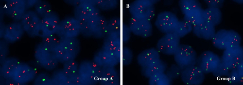 Figure 2 Representative FISH images of Group A breast cancer with HER2 ≥ 4.0 and < 6.0, and HER2/CEP17 ≥ 2.0 (A) and Group B breast cancer with HER2 ≥ 4.0 and < 6.0, and HER2/CEP17 < 2.0 (B).