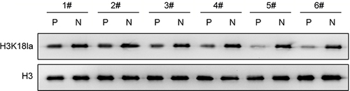 Figure 3 H3K18lac level was up-regulated in the psoriasis patients. The H3K18lac levels in the skin samples were detecting by Western blot assay using Anti-L-Lactyl-Histone H3.