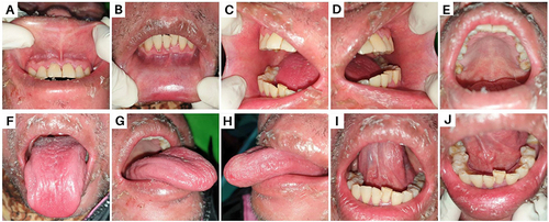 Figure 2 The clinical appearance of intraoral dryness: (A) Upper labial mucosa; (B) Lower labial mucosa; (C) Right buccal mucosa; (D) Left buccal mucosa; (E) Palatum; (F) Tongue dorsum; (G) Right lateral tongue; (H) Left lateral tongue; (I) Tongue ventral; (J) Floor of the mouth.