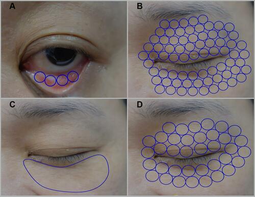 Figure 1 Treatment areas of steps 1, 2, 3, and 4 of laser treatment. (A) Ten passes with 10 stag pulses using transconjunctival approach in step 1. (B) Three passes with three stag pulses using cutaneous approach on periorbital skin of upper and lower eyelids in step 2. (C) Five passes or until the skin temperature exceeds 40–42°C for 2–3 minutes using cutaneous approach on bulging fat in the lower eyelid in step 3. (D) Three passes using cutaneous approach on periorbital skin of upper and lower eyelids in step 4.