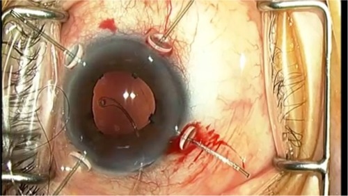 Figure 2 Intraoperative photograph showing capsule retractors stenting the capsular bag during phacoemulsification.
