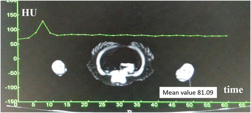 Figure 2. Time–density curve. The enhancement peak appeared at 7 s.