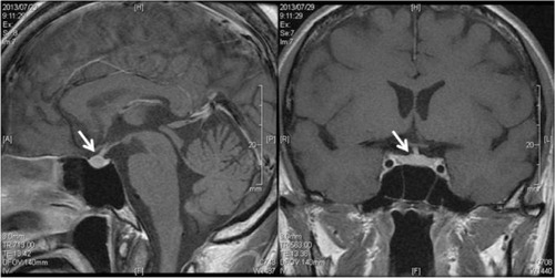 Figure 1 Gadlinium-enhanced pituitary MRI (T1-weighted images).