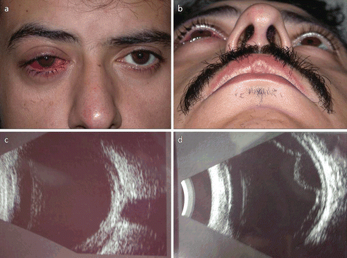 FIGURE 1  (a)The right eye is injected, and with marked proptosis (4 mm). (b) The proptosis in the right eye is more significant in the supine position. (c) B-scan USG showing a sub-Tenon’s effusion at the junction of the optic nerve and globe (T-sign). (d) B-scan USG showing choroidal effusion and exudative retinal detachment.