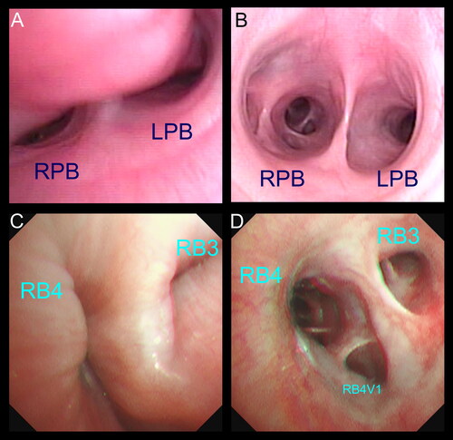Figure 1. The definitive diagnosis of canine bronchomalacia was made by bronchoscopy in this study. (A) Bronchoscopic view showing severe collapse of the left and right principal bronchus (LPB and RPB). (B) Bronchoscopic image at the same level of the carina from a dog without bronchomalacia. (C, D) Bronchoscopic images demonstrating the dynamic collapse of the lobar bronchus of the accessory lobe (RB3) and the right caudal lobe (RB4) in a dog with severe bronchomalacia.