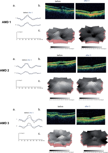 Figure 4 The mfERG and OCT results for the AMD 1 (A), AMD 2 (B) and AMD 3 (C) are demonstrated. The mfERG central and peripheral area waveform averages (a) and OCT images (b) before and after three treatments are shown for each patient. In c. the three dimensional response density plots of each patient compared with the age-similar control group (n = 20) are outlined before and after three treatments with ranibizumab. Note that darker gray scales indicate poorer response densities which were evident in all patients after the third treatment. These were not only reduced in the central area but throughout the whole field up to 25° (see also waveform averages in a).