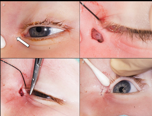 Figure 4. Lacrimal fistula and its surgical treatment.