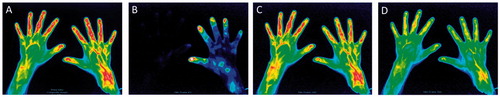 Figure 4. False positive findings in a healthy volunteer. A composite image (A) and representative images of Phase-1 (B), Phase-2 (C) and Phase-3 (D). The right wrist showed enhancement in the composite image and Phase-2. The PIP joints were also enhanced along with diffusely enhanced fingers in the composite image and Phase-2.