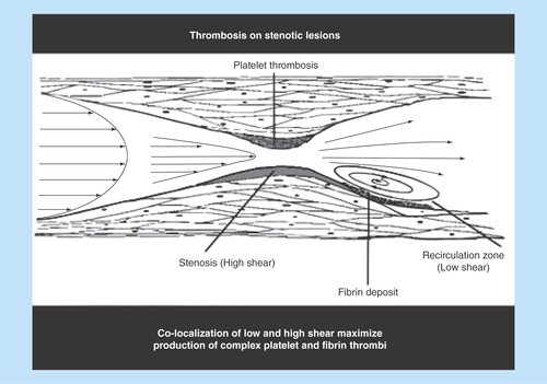 Figure 3.  Blood flow properties and thrombus formation at an atherosclerotic/stenotic lesion.