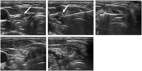 Figure 1. A 25-year-old woman presented with a recurrent tumor in the left neck operation bed close to the esophagus and tracheoesophageal groove (a). Before RFA, a hydrodissection technique was applied to obtain a safety margin from the esophagus and recurrent laryngeal nerve (b). An RF electrode with a 0.4 cm size active tip was inserted into the recurrent tumor and the ablation was started (c). During ablation, the patient complained that her voice had changed. Ablation was stopped immediately and a cold dextrose solution was injected directly around the ablated tumor (d). After injecting 15 ml of cold dextrose solution, the patient’s voice completely improved (e).